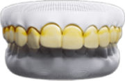 răng sứ veneer