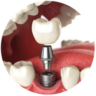 Trồng Răng Implant