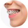 Niềng Răng Thẩm Mỹ