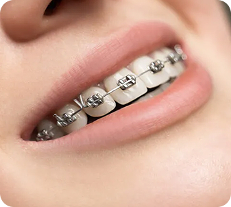 Niềng Răng Mắc Cài Kim Loại Tiêu Chuẩn