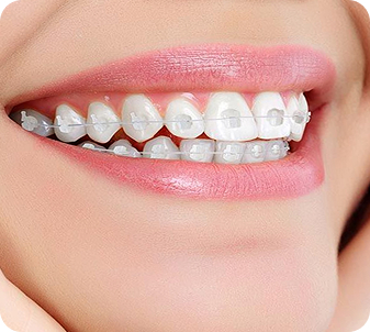 Niềng Răng Mắc Cài Sứ Tiêu Chuẩn