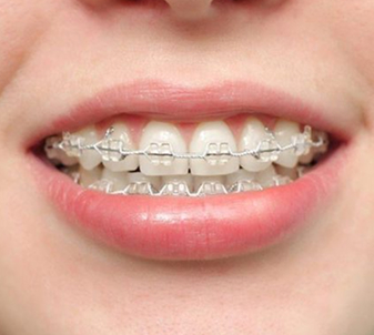 Niềng Răng Mắc Cài Tự Buộc