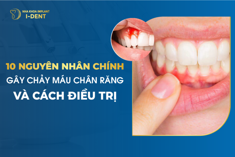 10 Nguyên Nhân Chính Gây Chảy Máu Chân Răng Và Cách Điều Trị
