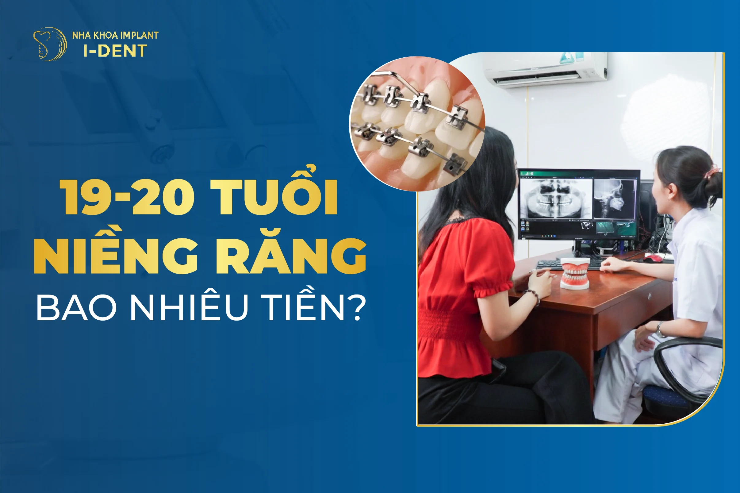 19 20 Tuoi Nieng Rang Bao Nhieu Tien