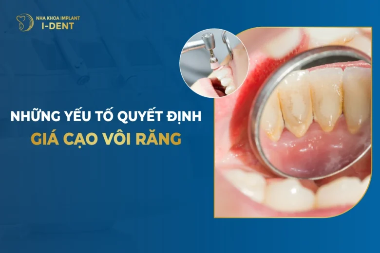 Chi Phí Lấy Cao Răng: Bảng Giá 2026 Và Các Yếu Tố Ảnh Hưởng