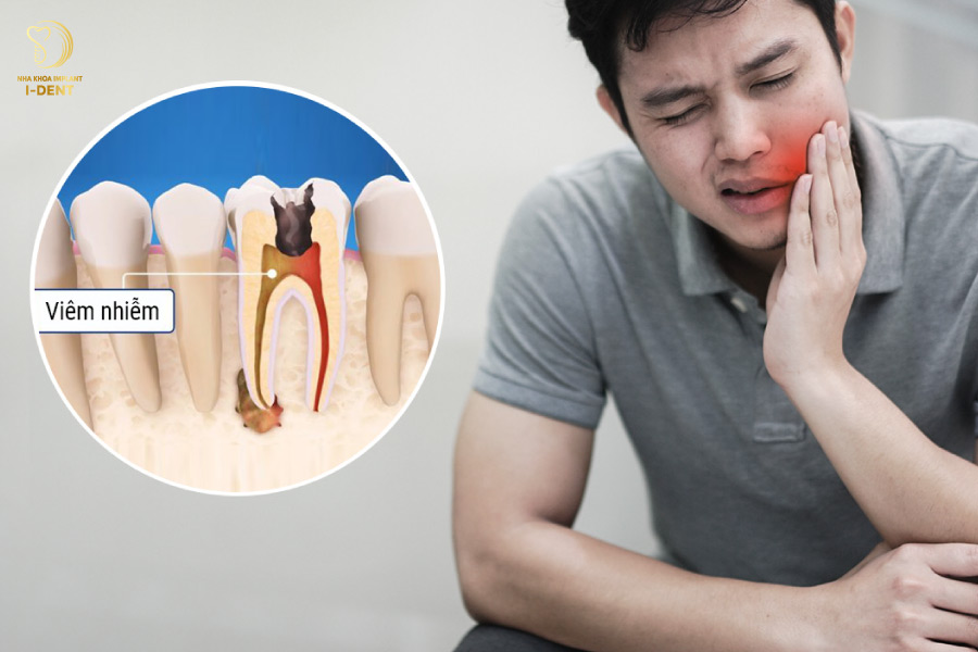 bọc răng sau khi lấy tủy