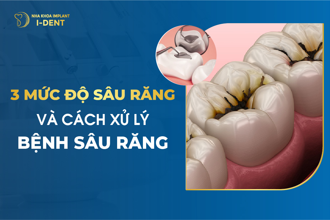 3 Muc Do Sau Rang Va Cach Xu Ly Benh Sau Rang
