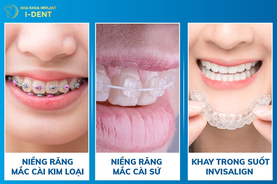 niềng răng cho người 25 tuổi