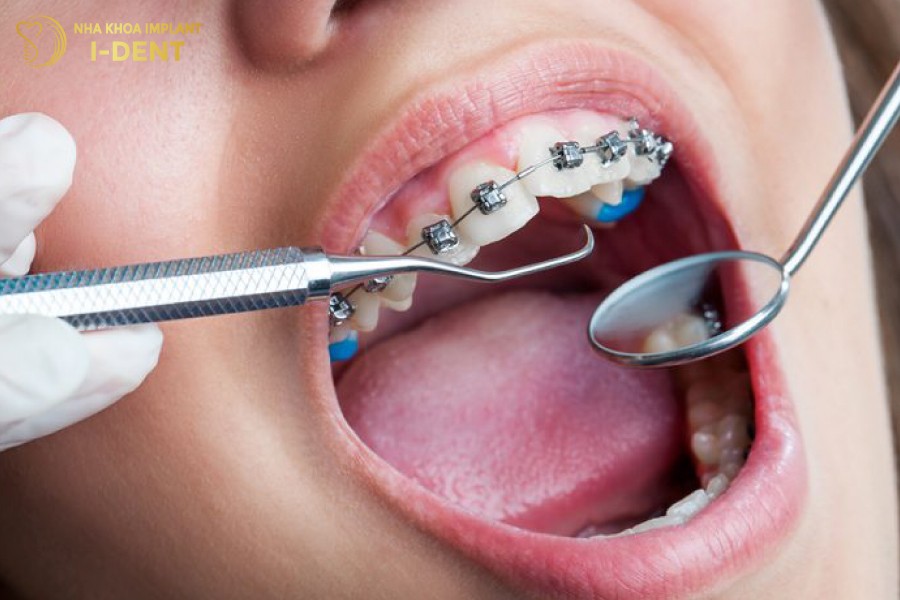 niềng răng 1 hàm mất bao lâu