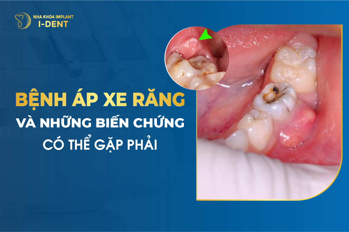 Benh Ap Xe Rang Va Nhung Bien Chung Co The Gap Phai