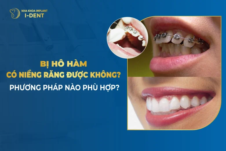 Răng Bị Hô Hàm Trên Có Niềng Được Không?