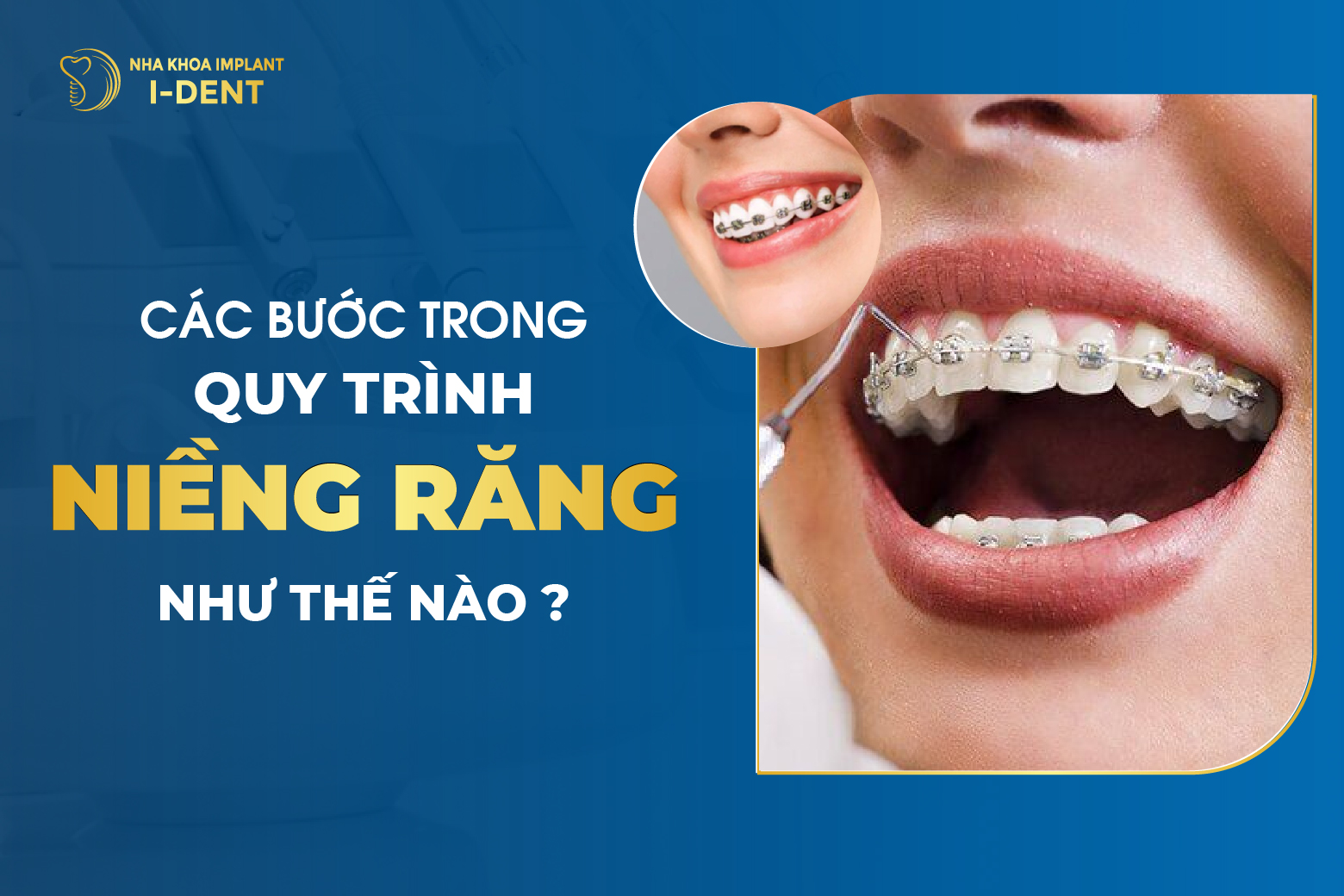 Cac Buoc Trong Quy Trinh Nieng Rang Nhu The Nao