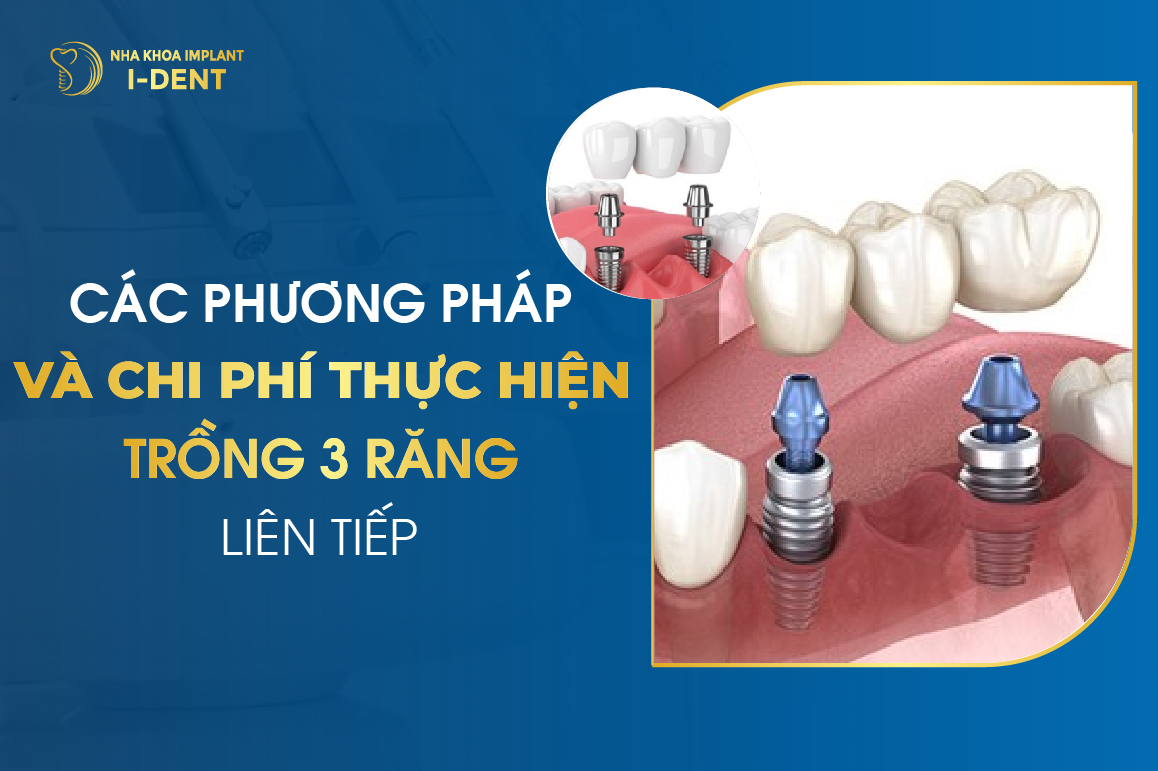Cac Phuong Phap Va Chi Phi Thuc Hien Trong 3 Rang Lien Tiep 1