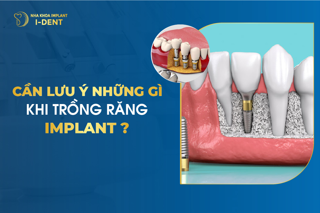Can Luu Y Nhung Gi Khi Trong Rang Implant