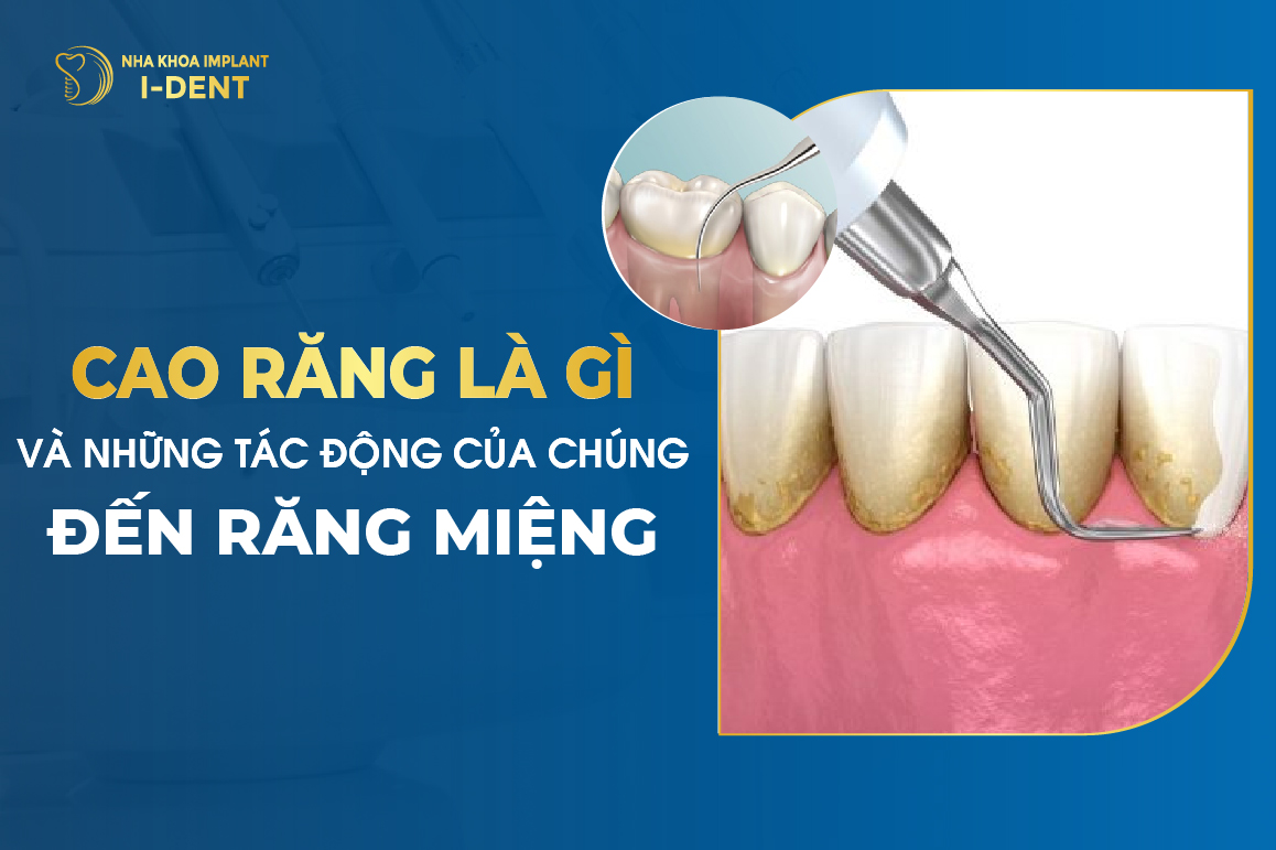 Cao Rang La Gi Va Nhung Tac Dong Cua Chung Den Rang Mieng