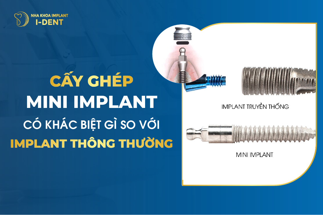 Cay Ghep Mini Implant Co Khac Biet Gi So Voi Implant Thong Thuong
