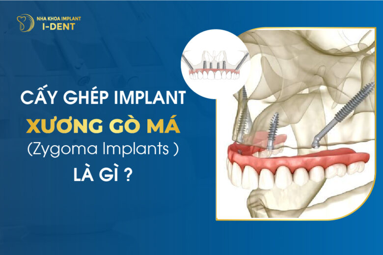 Cấy Ghép Implant Xương Gò Má (Zygoma Implants) Là Gì?