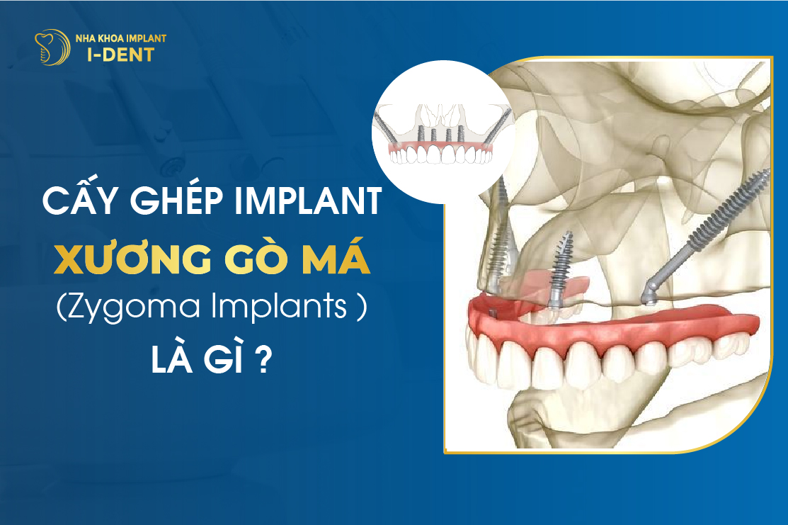 Cay Ghep Implant Xuong Go Ma Zygoma Implants La Gi