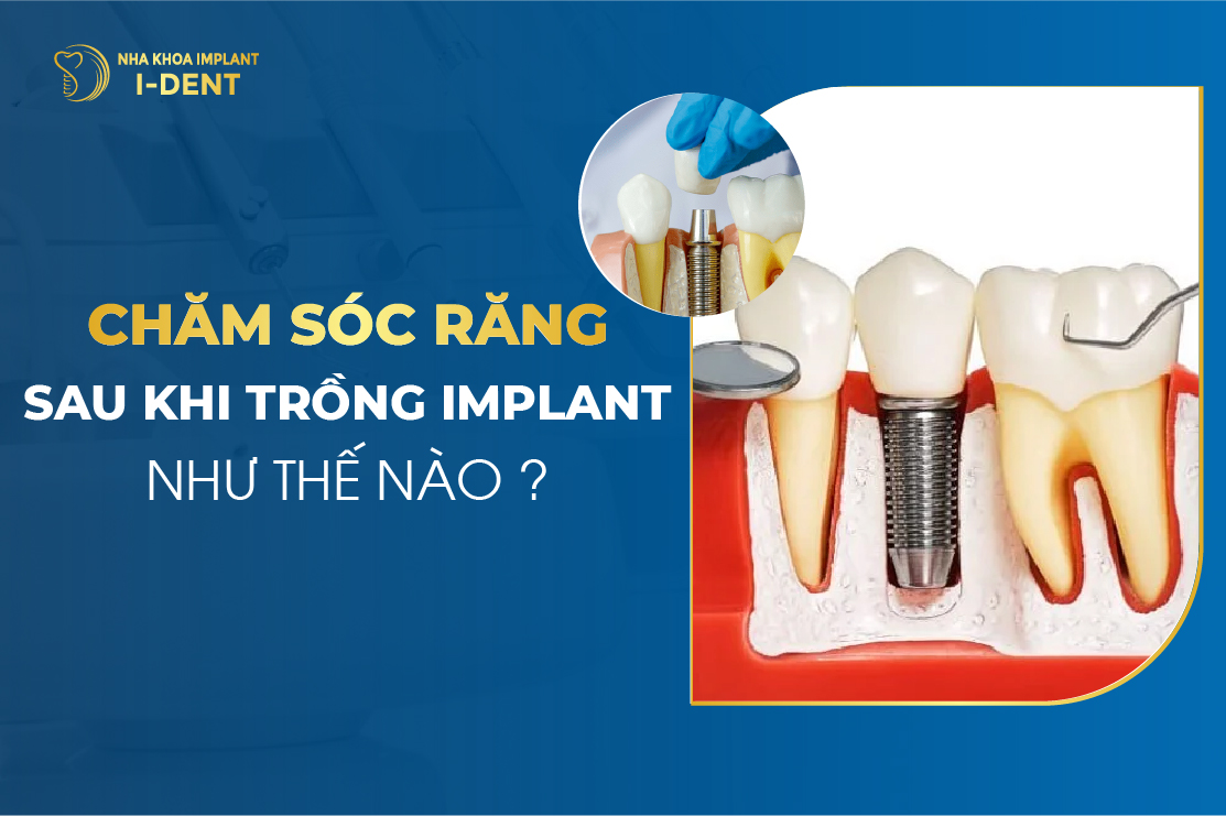 Cham Soc Rang Sau Khi Trong Implant Nhu The Nao 1