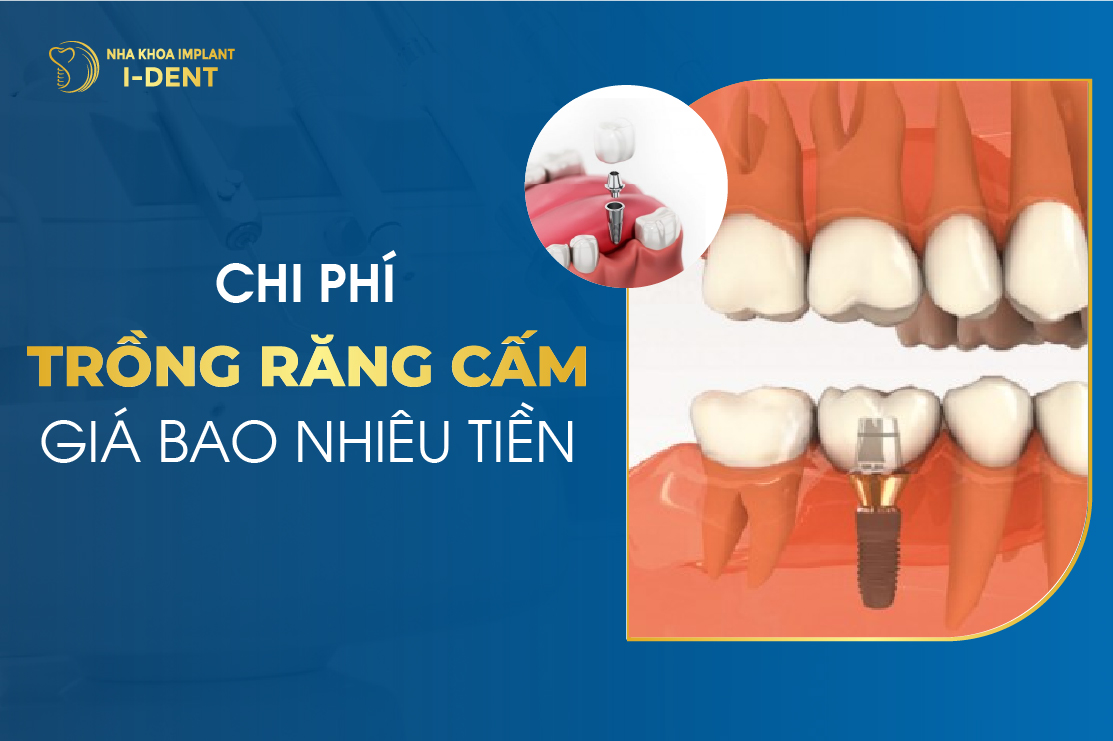 Chi Phi Trong Rang Cam Gia Bao Nhieu Tien