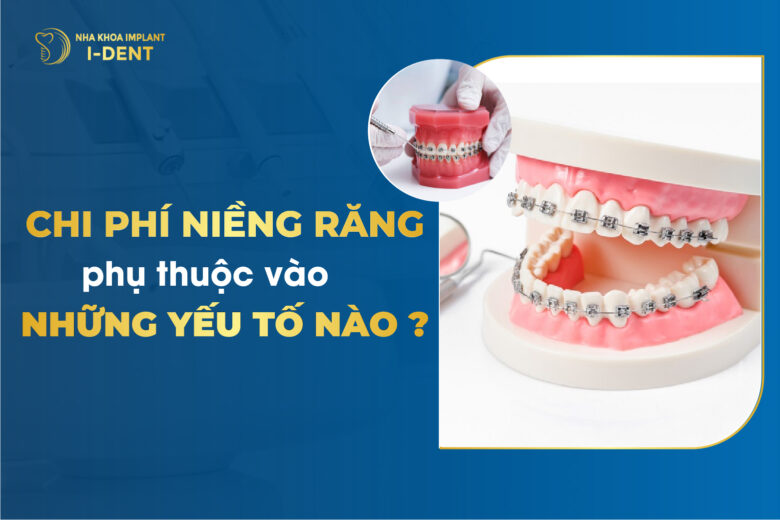 [Tháng 3/2026] Niềng Răng Giá Bao Nhiêu? Chi Phí Mới Nhất