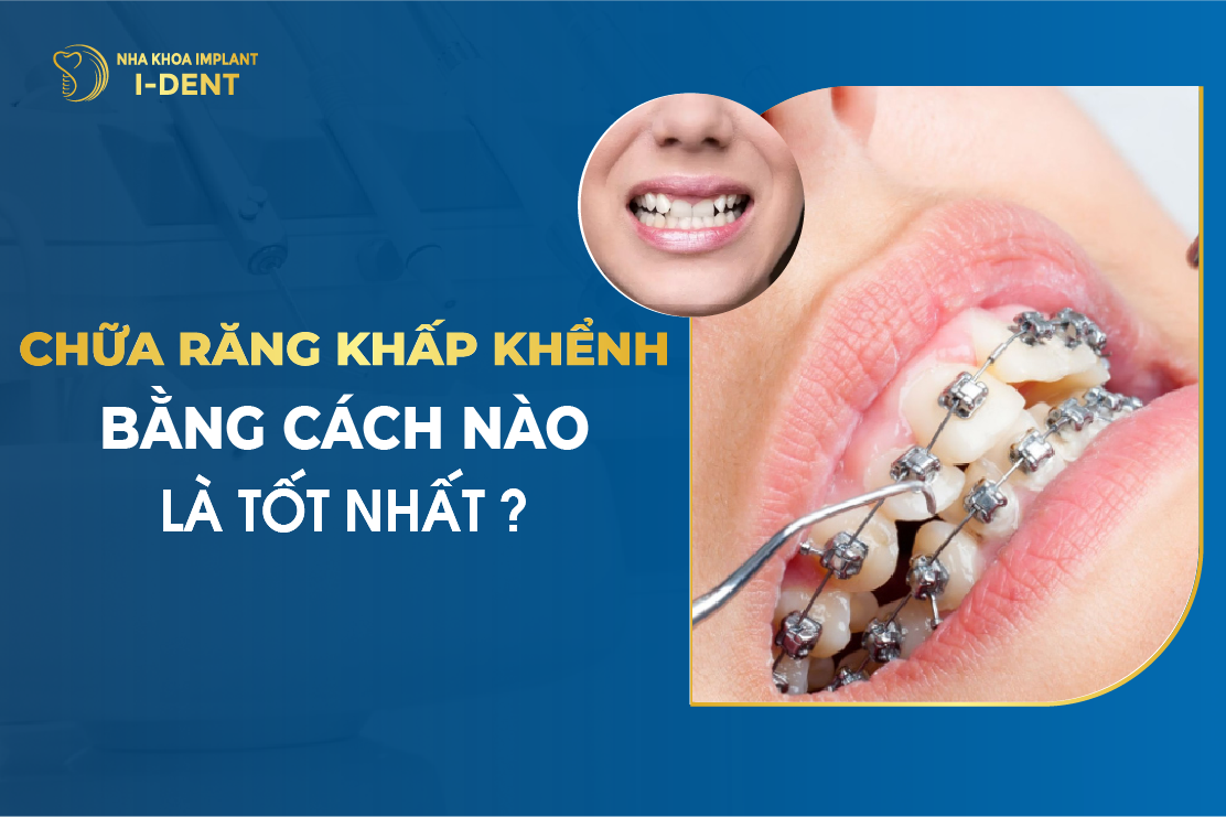 Chua Rang Khap Khenh Bang Cach Nao La Tot Nhat
