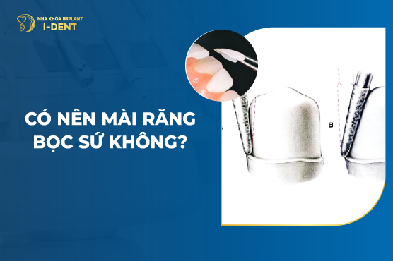 Có Nên Mài Răng Bọc Sứ Không? Nha Khoa I Dent