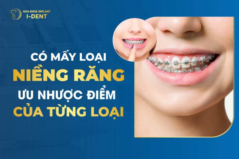 Các Loại Niềng Răng Phổ Biến Nhất Năm 2026