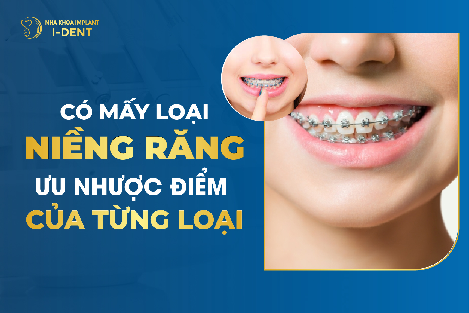 Co May Loai Nieng Rang Uu Nhuoc Diem Cua Tung Loai
