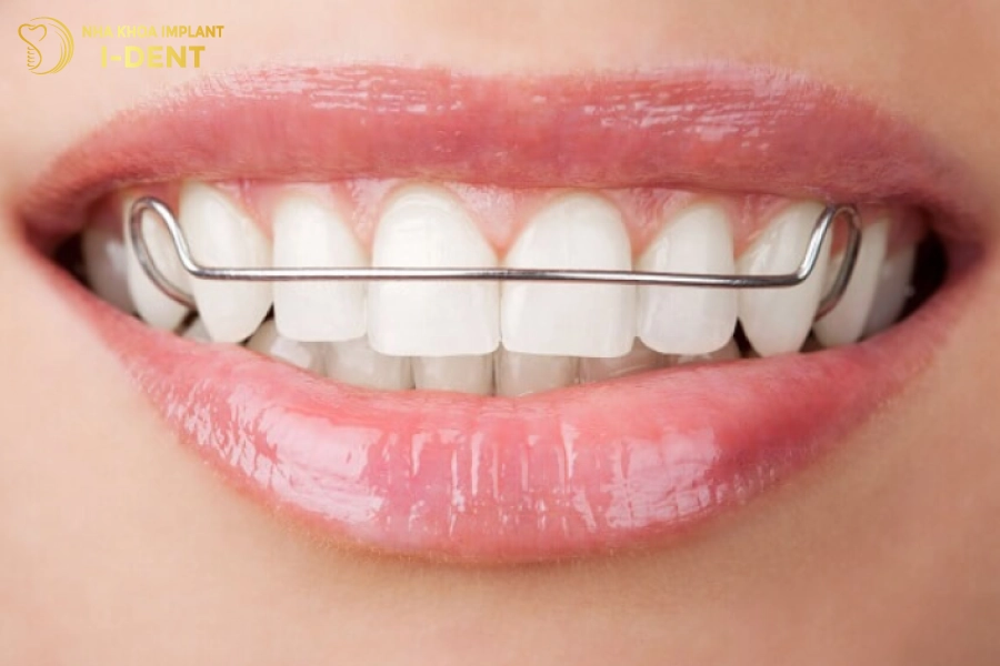 Đeo hàm duy trì để tránh răng chạy về vị trí cũ