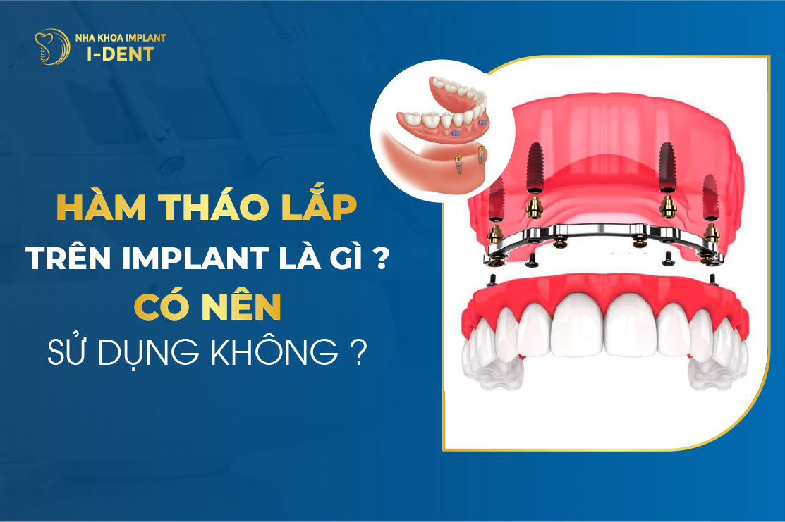 Ham Thao Lap Tren Implant La Gi Co Nen Su Dung Khong