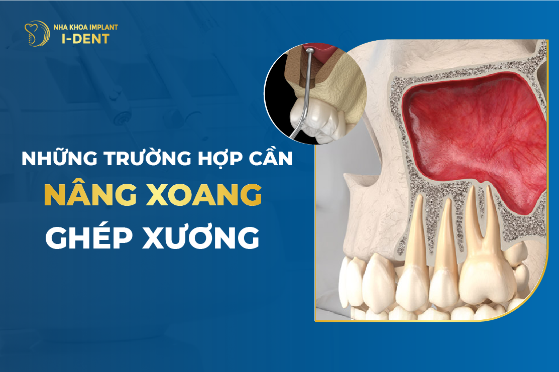 Hoi Han Khi Trong Implant Gia Re – Tien Mat Tat Mang