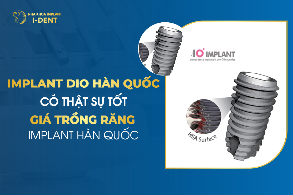 Implant Dio Han Quoc Co That Su Tot – Gia Trong Rang Implant Han Quoc