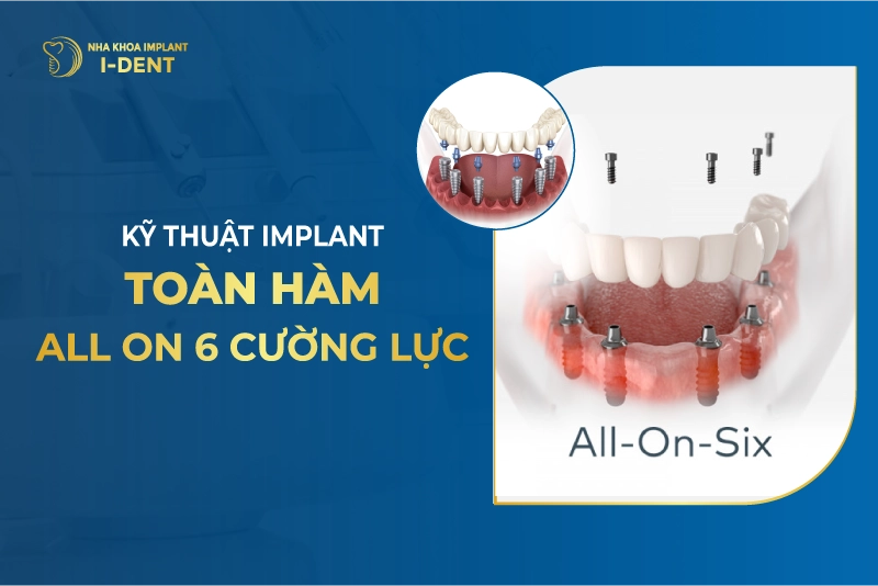 Ky Thuat Implant Toan Ham 1