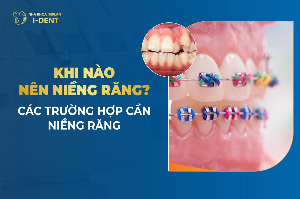 Khi Nao Nen Nieng Rang Cac Truong Hop Can Nieng Rang