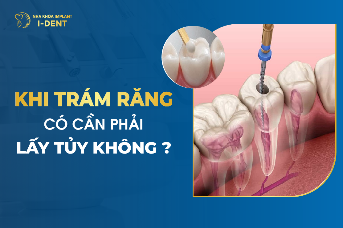 Khi Tram Rang Co Can Phai Lay Tuy Khong