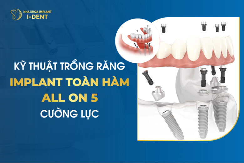 Kỹ Thuật Trồng Răng Implant Toàn Hàm All On 5 Cường Lực