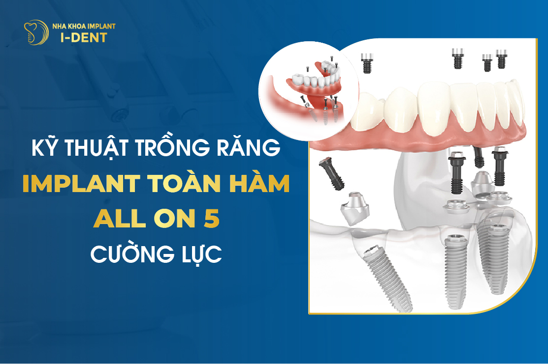 Ky Thuat Trong Rang Implant Toan Ham All On 5 Cuong Luc