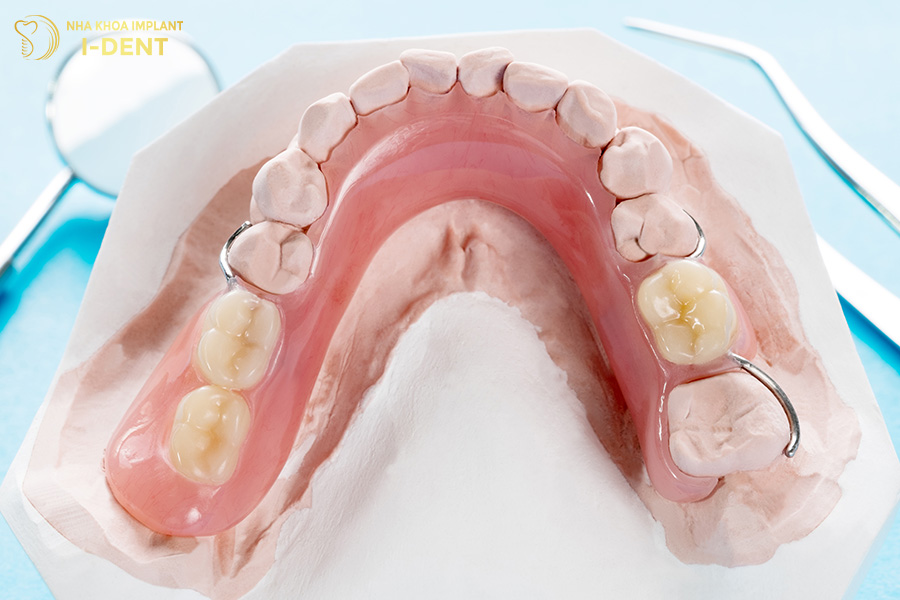 trồng răng hàm bị sâu