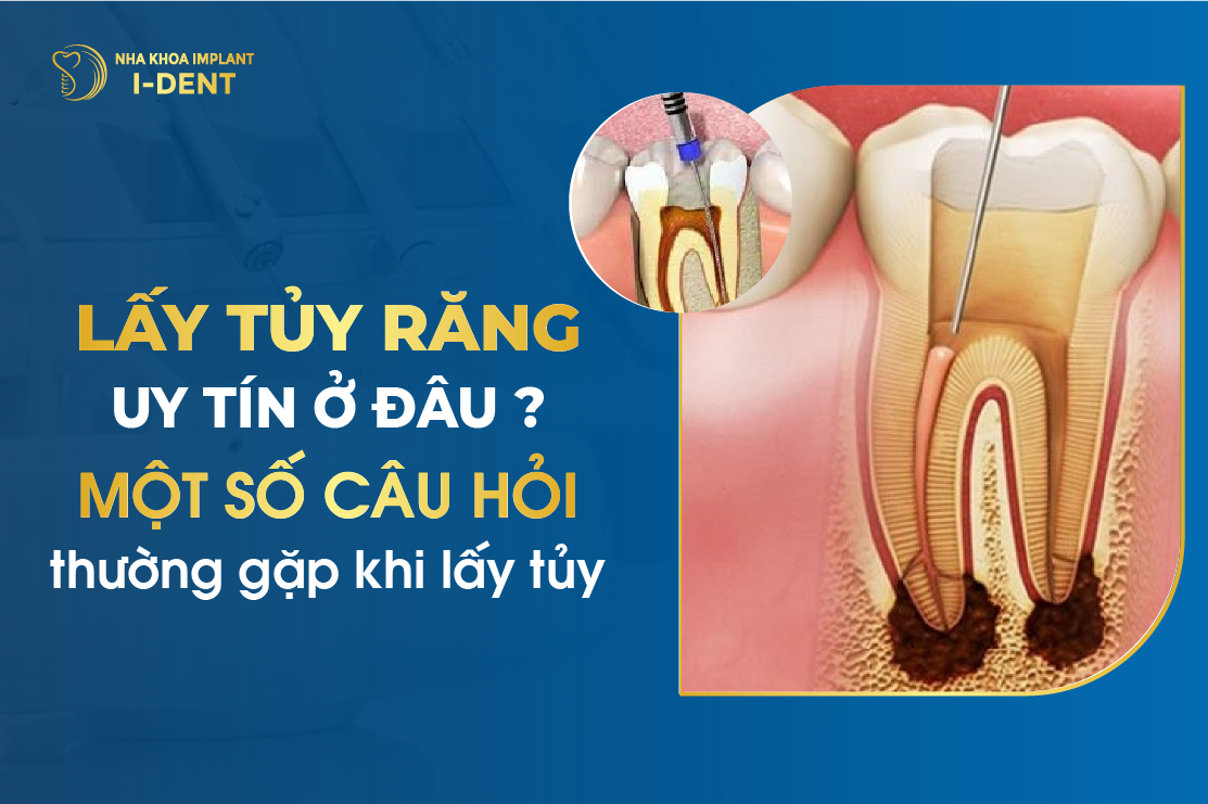 Lay Tuy Rang Uy Tin O Dau Mot So Cau Hoi Thuong Gap Khi Lay Tuy 1