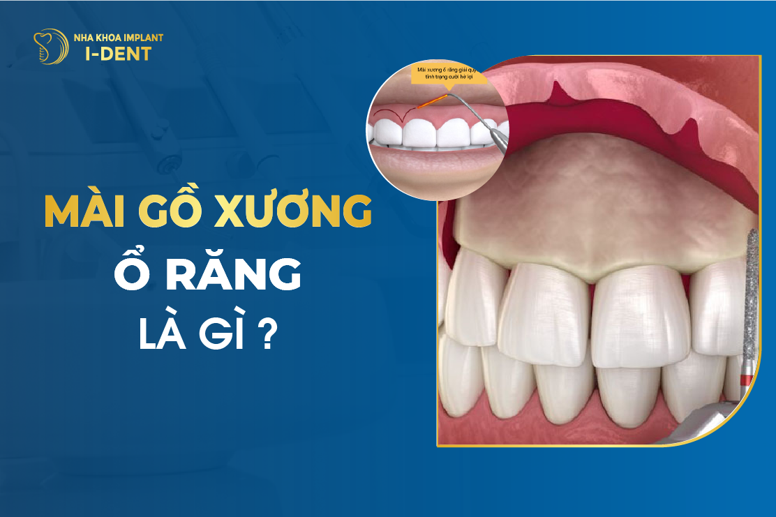 Mai Go Xuong O Rang La Gi