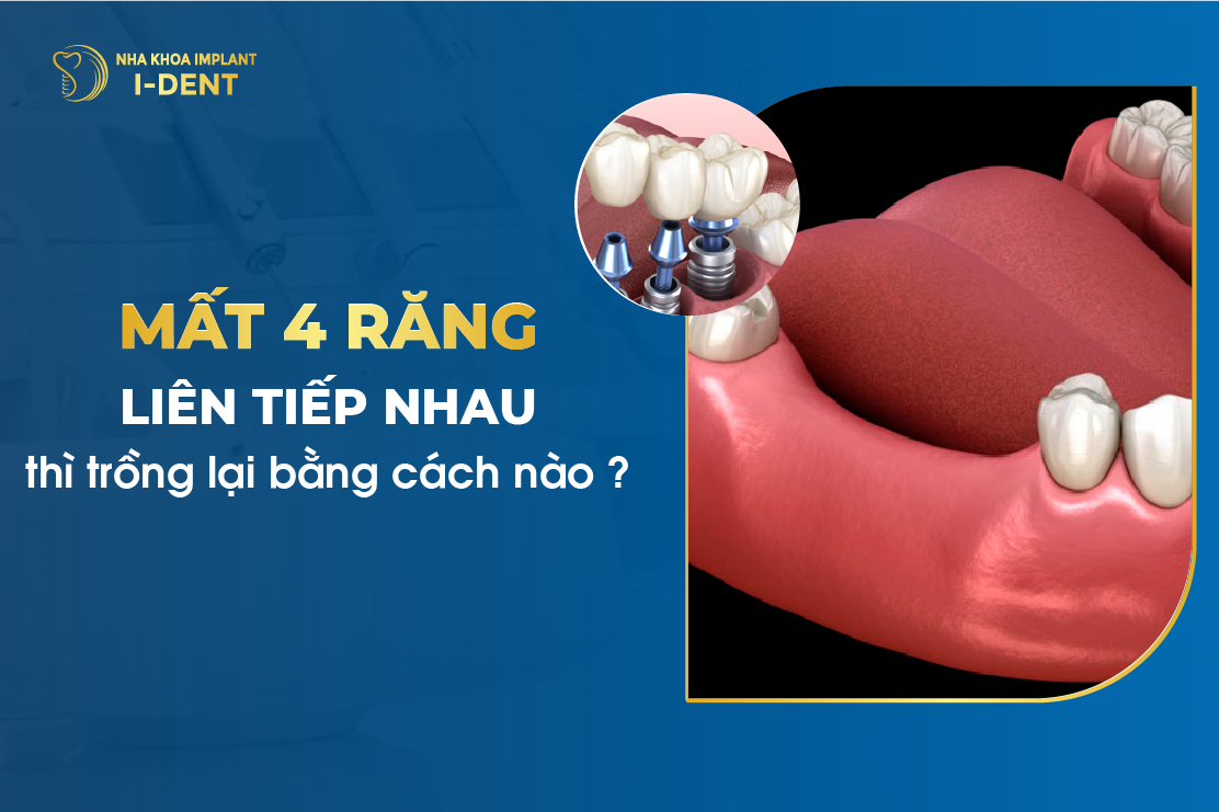Mat 4 Rang Lien Tiep Nhau Thi Trong Lai Bang Cach Nao