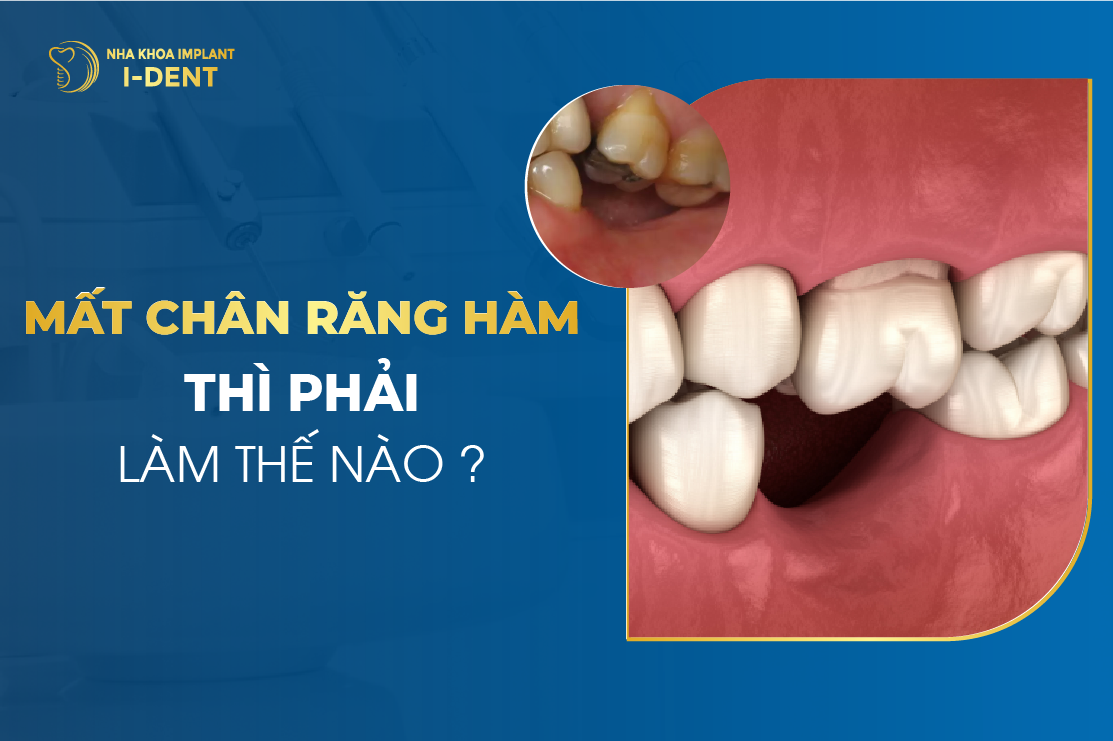 Mat Chan Rang Ham Thi Phai Lam The Nao