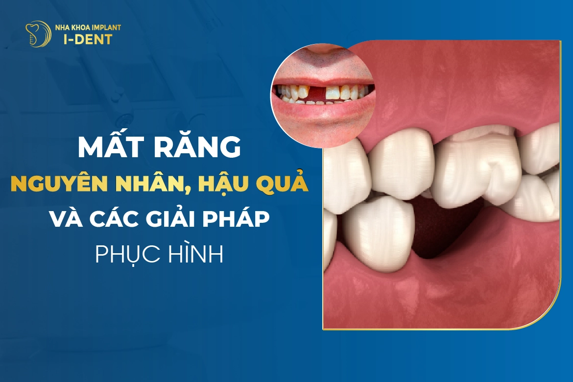 Mat Rang Nguyen Nhan Hau Qua Va Cac Giai Phap Phuc Hinh