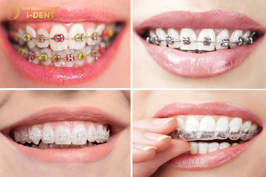 Mỗi loại mắc cài niềng răng sẽ có chi phí thực hiện khác nhau