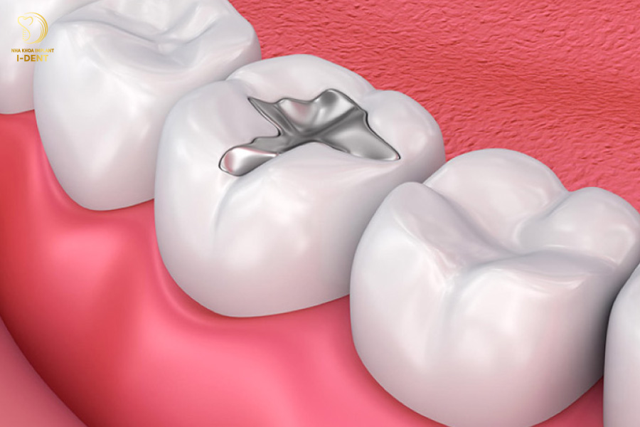 Trám răng giá bao nhiêu?Trám răng bằng Amalgam