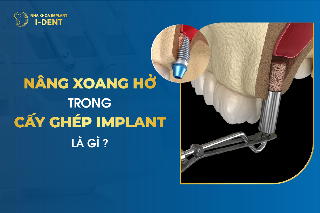 Nang Xoang Ho Trong Cay Ghep Implant La Gi