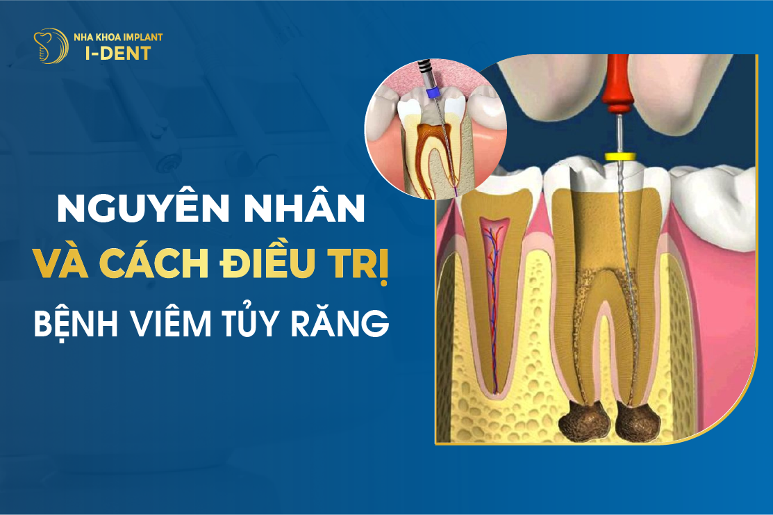 Nguyen Nhan Va Cach Dieu Tri Benh Viem Tuy Rang