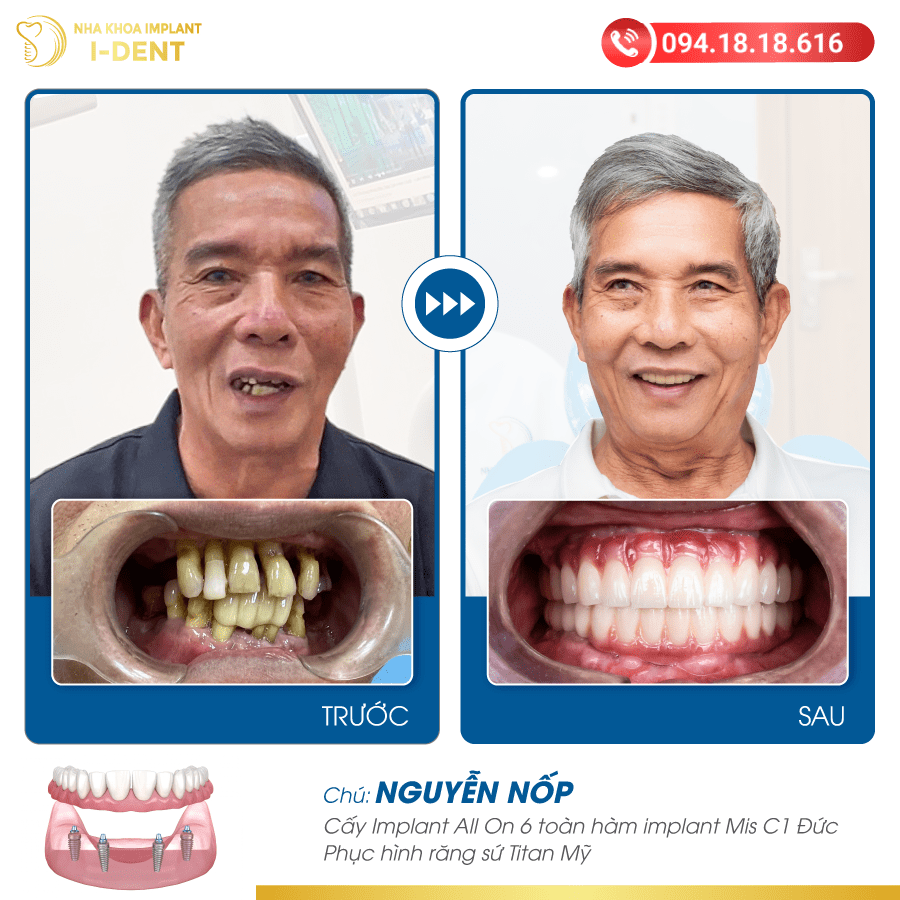 Nguyễn Nốp-01