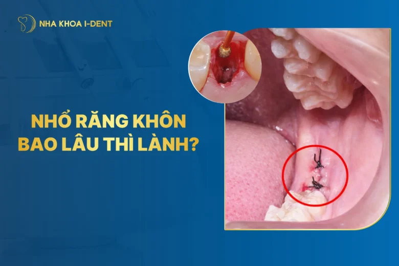 Nhỏ Răng Khôn Bao Lâu Thì Lành? Làm Gì Để Lành Thương Nhanh?